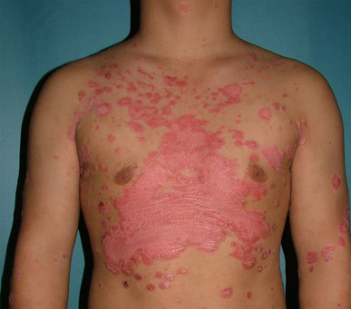 儿童湿疹图片初期症状图片