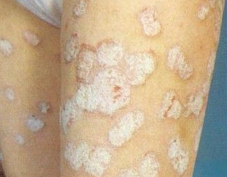 湿疹和银屑病的区别图片