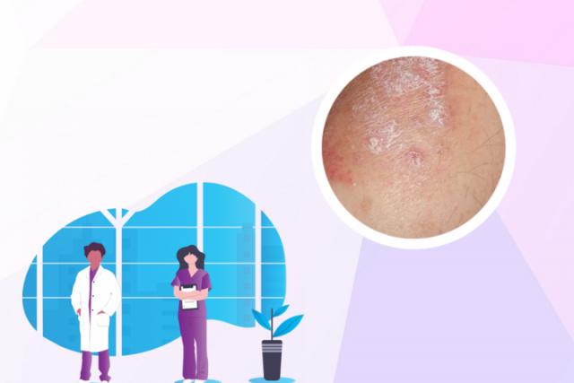 湿疹和皮肤癣哪个更难治愈
